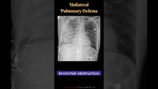 Unilateral Pulmonary Oedema Differential Diagnosis Radiology tutorials shorts [upl. by Bartko]