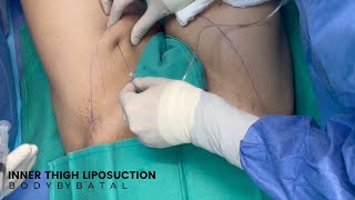 Inner Thigh Liposuction  Awake Liposuction [upl. by Navillus]