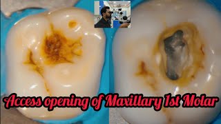 Access opening of Maxillary 1st Molarstep by step rootcanal treatment [upl. by Chrissa]