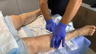 HOW TO REDUCE SWELLINGCOMPLICATIONS SCAR TISSUE AFTER LIPOSUCTION LYMPHATIC MASSAGEDr Jason Emer [upl. by Camey]