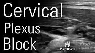 Cervical Plexus Block [upl. by Nyrat492]