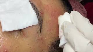 MAITRIX ACNE CÔNG NGHỆ MỚI TRONG ĐIỀU TRỊ MỤN [upl. by Weinman]