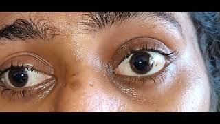 Complete Bilateral Ophthalmoplegia Video [upl. by Loggia]