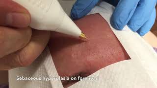 Sebaceous hyperplasia removal [upl. by Seitz687]