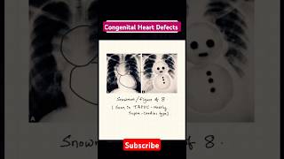 Congenital heat disease and their Characteristics shapes on radiograph heart defects neetpg [upl. by Ayotnahs]