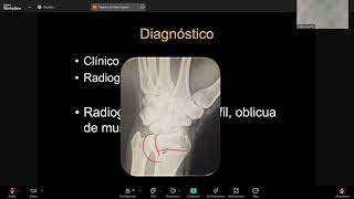 FRACTURA ARTICULAR  FRACTURA DE RADIO DISTAL [upl. by Alessandra]