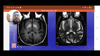 CNS imaging for beginners Mondini septooptic dysplasia etc [upl. by Mw]