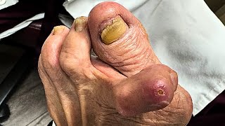 Ulcer Debridement and Extreme Nail Cutting On a 94YearOld Patients Deformed Toe [upl. by Haldis]