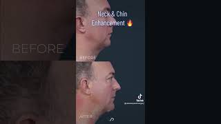 Neck Liposuction and Chin implant  BEFORE and AFTER [upl. by Gnehc921]