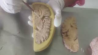 Anatomy of Internal capsule neuroanatomy dissection [upl. by Macknair]