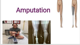 Amputation ¦ levels of Amputation  Orthopedic Nursing MSNAHN2 in hindi BSN lecture [upl. by Wiley]