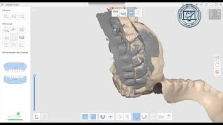 Recasing lower full denture with facebow based on IOS scan [upl. by Ressler]