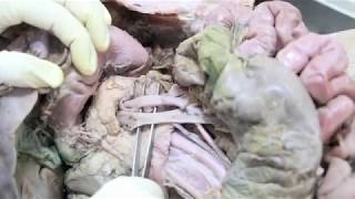 Anatomy Dissection of Pancreas amp Duodenum [upl. by Valerian]