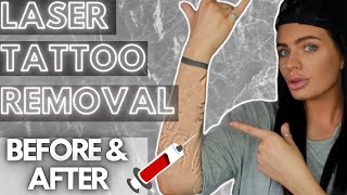 LASER TATTOO REMOVAL EXPERIENCE 💉 Before amp After  FAQs [upl. by Yeneffit]