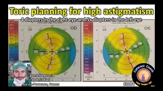 CataractCoach 1084 toric IOL planning for high corneal astigmatism [upl. by Jamie]