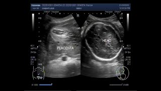 Ultrasound Video showing Oligohydromnios  almost Anhydramnios  with Pregnancy of 30 weeks [upl. by Lowenstein727]