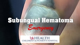 Subungual Hematoma Emergency and Trephination Procedure [upl. by Shelton]