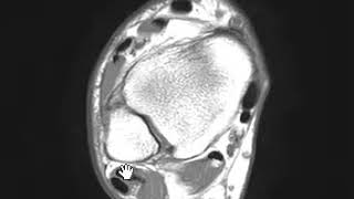 Peroneus brevis tendon longitudinal split tear [upl. by Sonnie]