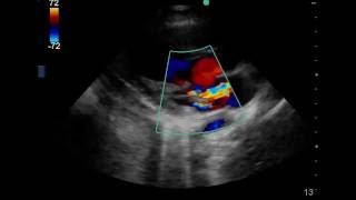 11 yo Girl with Fever Of Unknown Origin x 2 weeks with 1 day of Confusion [upl. by Neiv142]