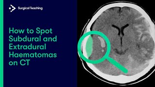 Extradural vs Subdural Haematomas  How do we Diagnose them on CT [upl. by Agnella]