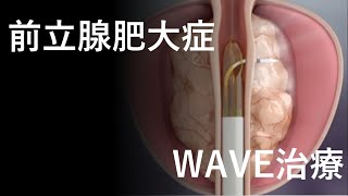 【前立腺肥大症】最新治療！ WAVE治療！！ [upl. by Gallagher807]