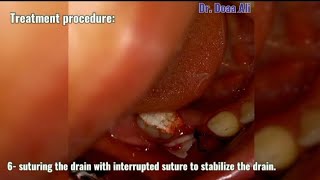 What is the role of drain in treatment of odontogenic infection [upl. by Jepum]