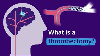 What is a thrombectomy [upl. by Clara]