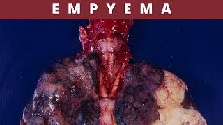 Empyema Causes Symptoms Treatment and Prevention [upl. by Anelrad]