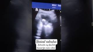 Vesical calculus on ultrasoundUrinary bladder pathology pelvic ultrasound [upl. by Alithea]