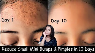 Get Rid of Pimples amp Acne Permanently with 2 products that changed your life [upl. by Mandle]