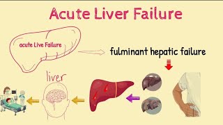 Acute Liver Failure Or Fulminant Hepatic Failure  Sign Symtoms  Causes  Risk Factors  Treatment [upl. by Epoh621]