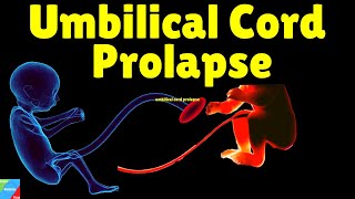 Umbilical Cord Prolapse  Cord Prolapse – Causes Symptoms amp Management [upl. by Earesed707]