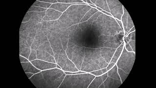 Fundus Fluorescein Angiographic Studies [upl. by Algar]