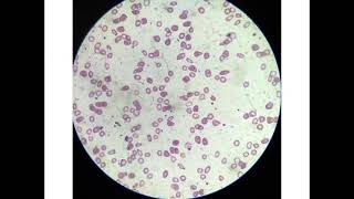 microcytic hypochromic anaemia [upl. by Laehcym109]