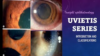 UVEITIS SERIES Classification Types and Pathology of Uveitis [upl. by Gilly]