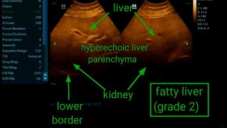 Fatty liver grade 2  ultrasound [upl. by Takara]