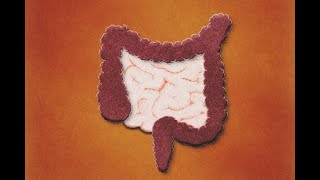 Patología Isquémica Intestinal Definición Evaluación Tratamiento [upl. by Norby853]