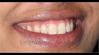 Beautification of Smile  Gingival Depigmentation [upl. by Arodnap]