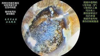 采耳哥Hard earwax embolism cleaning of ear canal and tympanic membrane dry film [upl. by Philan]