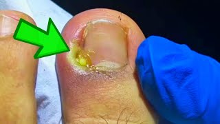 The WORST Infected Toenail Removal Youve Ever Seen [upl. by Glennis]