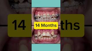 Orthodontics Case 14 Month Restoration [upl. by Ellitnahc]