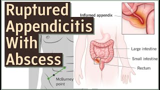 Ruptured Appendicitis with Abscess [upl. by Etteiluj]