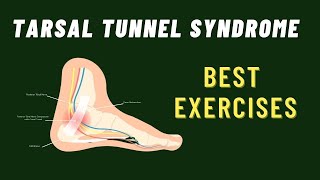 Tarsal Tunnel Syndrome 6 Best Exercises [upl. by Aikrahs]