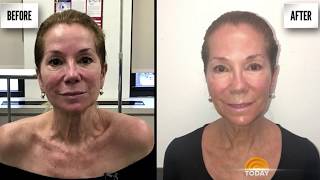 Kathie Lee Loves the Aerolase NeoSkin Rejuvenation Treatment [upl. by Thetos]