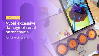 How to avoid excessive damage of renal parenchyma  Partial Nephrectomy [upl. by Adair507]