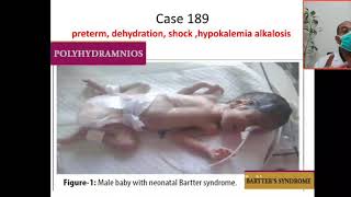 Case 189 hypokalemic metabolic alkalosis Bartter syndrome hyperprostaglandin Syndrome hypercalciu [upl. by Ettelracs832]