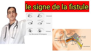 le signe de la fistule [upl. by Halehs]