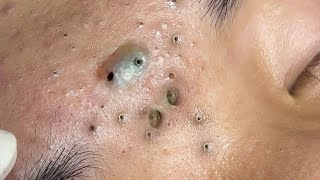 Big Cystic Acne Blackheads Extraction Blackheads amp Milia Whiteheads Removal Pimple Popping  2632 [upl. by Itnaihc]