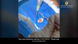 Root canal disinfection with the DStorm™ Diode Laser [upl. by Reinhold741]