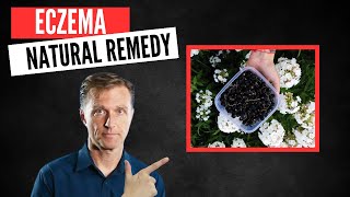 Best Natural Remedy for Eczema [upl. by Aneeuq]